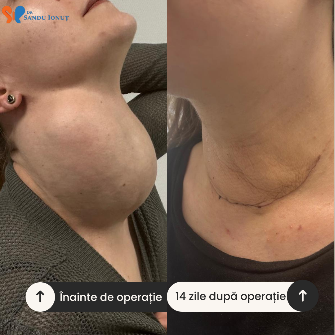 Cea mai mare tumoră tiroidiană operată în Europa
